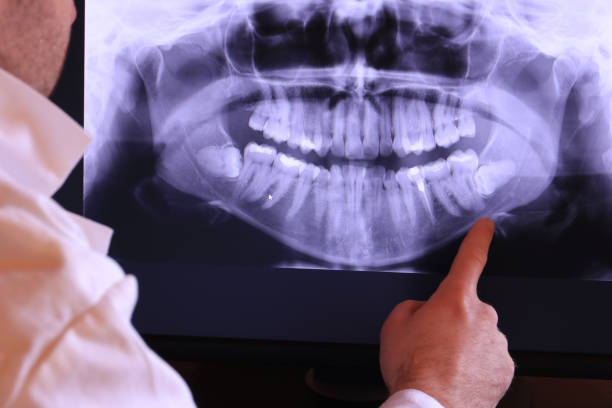 Best Emergency Wisdom Teeth Removal in Robesonia, PA