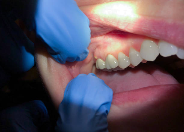 Best Emergency Treatment for Toothache in Robesonia, PA